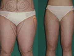 豐臺吸脂整形_正規(guī)的吸脂整形公司推薦